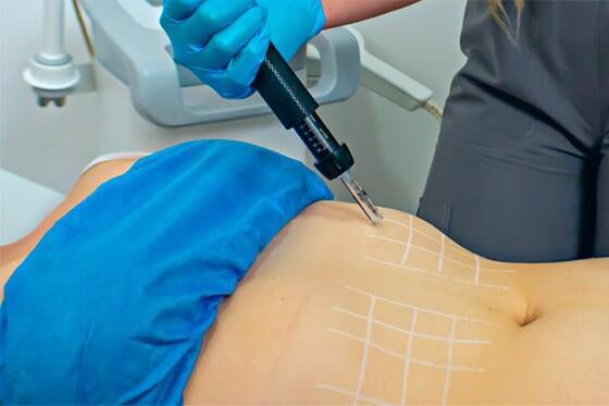 Lipodilucion-Cuenca Paciente haciéndose tratamiento en cuenca