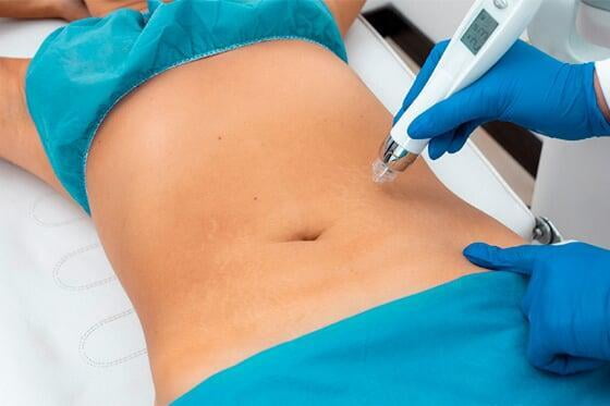 tratamiento-lipo-sin-cirugia