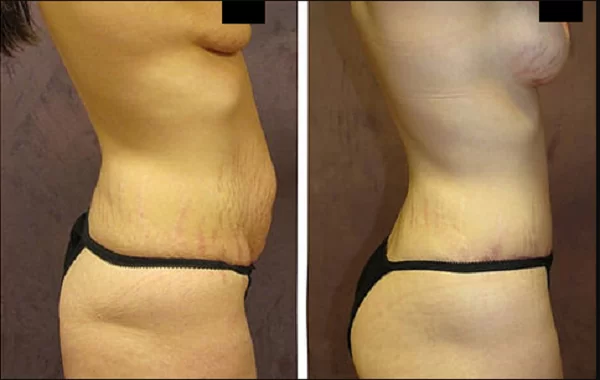Fibrosis-despues-de-una-liposuccion-Por-que-se-forma-y-como-combatirla