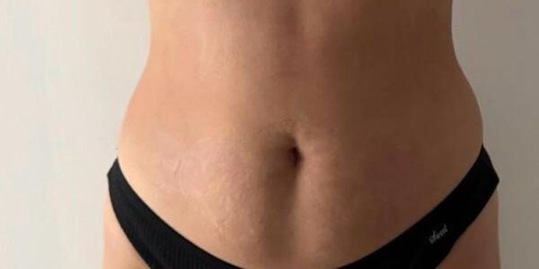 ofrecemos el tratamiento de lipodilución, una técnica estética no invasiva diseñada para reducir la grasa localizada en zonas como abdomen, brazos, muslos y papada