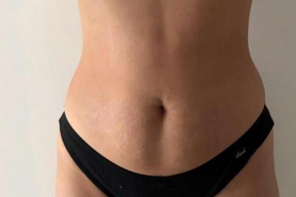 ofrecemos el tratamiento de lipodilución, una técnica estética no invasiva diseñada para reducir la grasa localizada en zonas como abdomen, brazos, muslos y papada