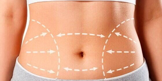 Lipodilucion-Cuenca Con la lipodilución logramos resultados estéticos visibles, seguros y rápidos, ideal para quienes quieren moldear su cuerpo sin cirugía