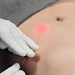 Endolift: Tecnología Láser para Tensar y Definir la Piel