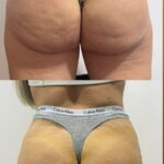 LEVANTAMIENTO DE GLUTEOS