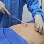 tratamientos-alternativos-endolifting-laser-abdominal